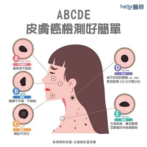 為什麼會長黑痣|痣變大、痣多或長毛會變皮膚癌？認識痣的形成與原因